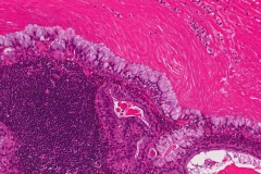 Mucoepidermoid carcinoma