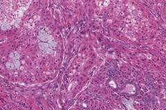 Mucoepidermoid carcinoma