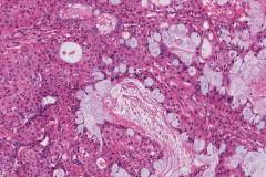 Mucoepidermoid carcinoma | Atlas of Pathology