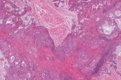 Mucoepidermoid carcinoma