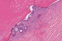 Mucoepidermoid carcinoma