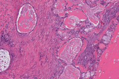 Mucoepidermoid carcinoma