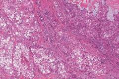 Mucoepidermoid carcinoma