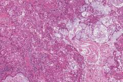 Mucoepidermoid carcinoma