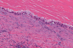 Mucoepidermoid carcinoma