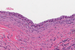 Mucoepidermoid carcinoma