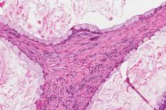 Mucoepidermoid carcinoma