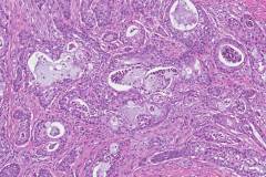 Mucoepidermoid carcinoma