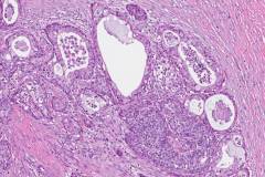 Mucoepidermoid carcinoma