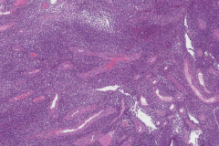 Mucosal melanoma of the nasal cavity and paranasal sinuses | Atlas of ...