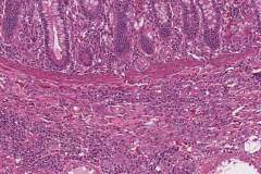 Myeloid sarcoma involving the small intestine