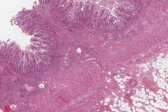 Myeloid sarcoma involving the small intestine