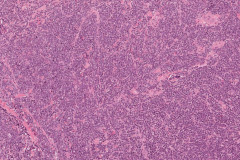 Myeloid sarcoma involving the oral cavity