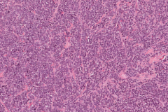 Myeloid sarcoma involving the oral cavity