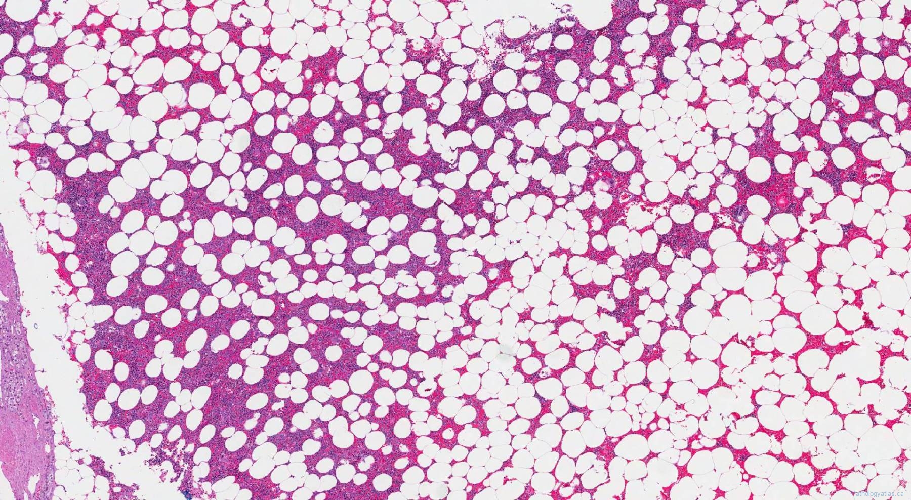 myelolipoma-atlas-of-pathology