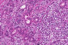 Myoepithelial carcinoma of the parotid gland