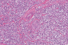 Myoepithelial carcinoma of the parotid gland