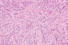 Myoepithelial carcinoma of the parotid gland