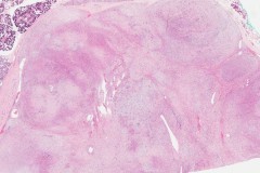 Myoepithelial carcinoma of the parotid gland