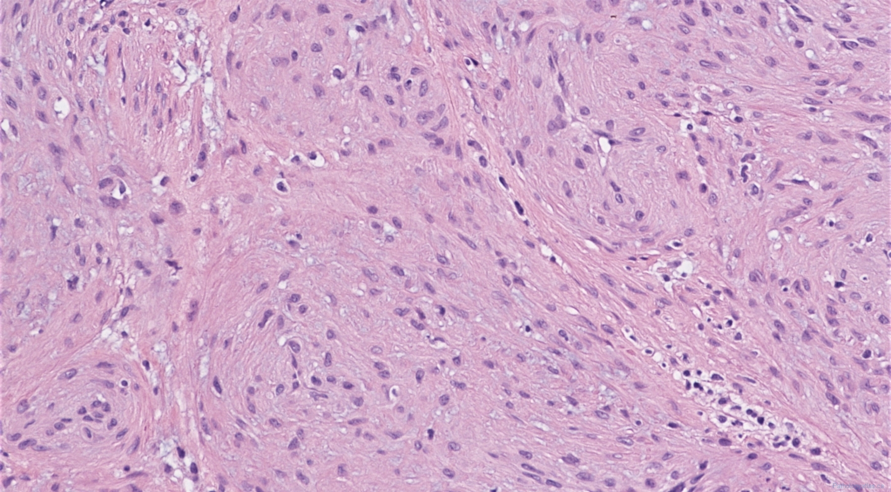 Myopericytoma | Atlas of Pathology