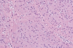 Myopericytoma | Atlas of Pathology