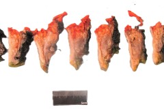 Myxofibrosarcoma