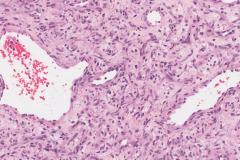 Myxoid hemangioma nasal cavity