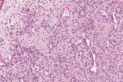 Myxoid hemangioma nasal cavity