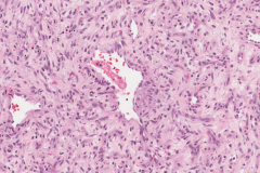 Myxoid hemangioma nasal cavity