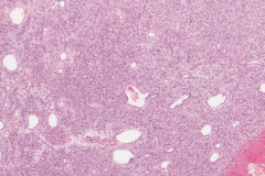 Myxoid hemangioma nasal cavity