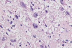 Myxoinflammatory fibroblastic sarcoma