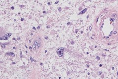 Myxoinflammatory fibroblastic sarcoma