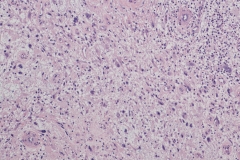 Myxoinflammatory fibroblastic sarcoma