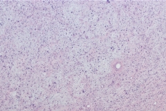 Myxoinflammatory fibroblastic sarcoma