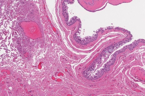 Nasolabial cyst | Atlas of Pathology