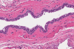 Nasolabial cyst