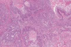 Keratinizing type nasopharyngeal carcinoma