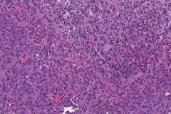 Nasopharyngeal carcinoma