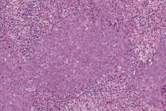 Nasopharyngeal carcinoma