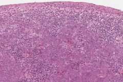 Nasopharyngeal carcinoma