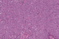 Nasopharyngeal carcinoma