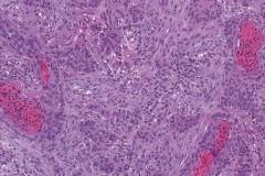 Keratinizing squamous cell carcinoma of the nasopharynx