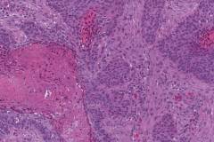 Keratinizing squamous cell carcinoma of the nasopharynx