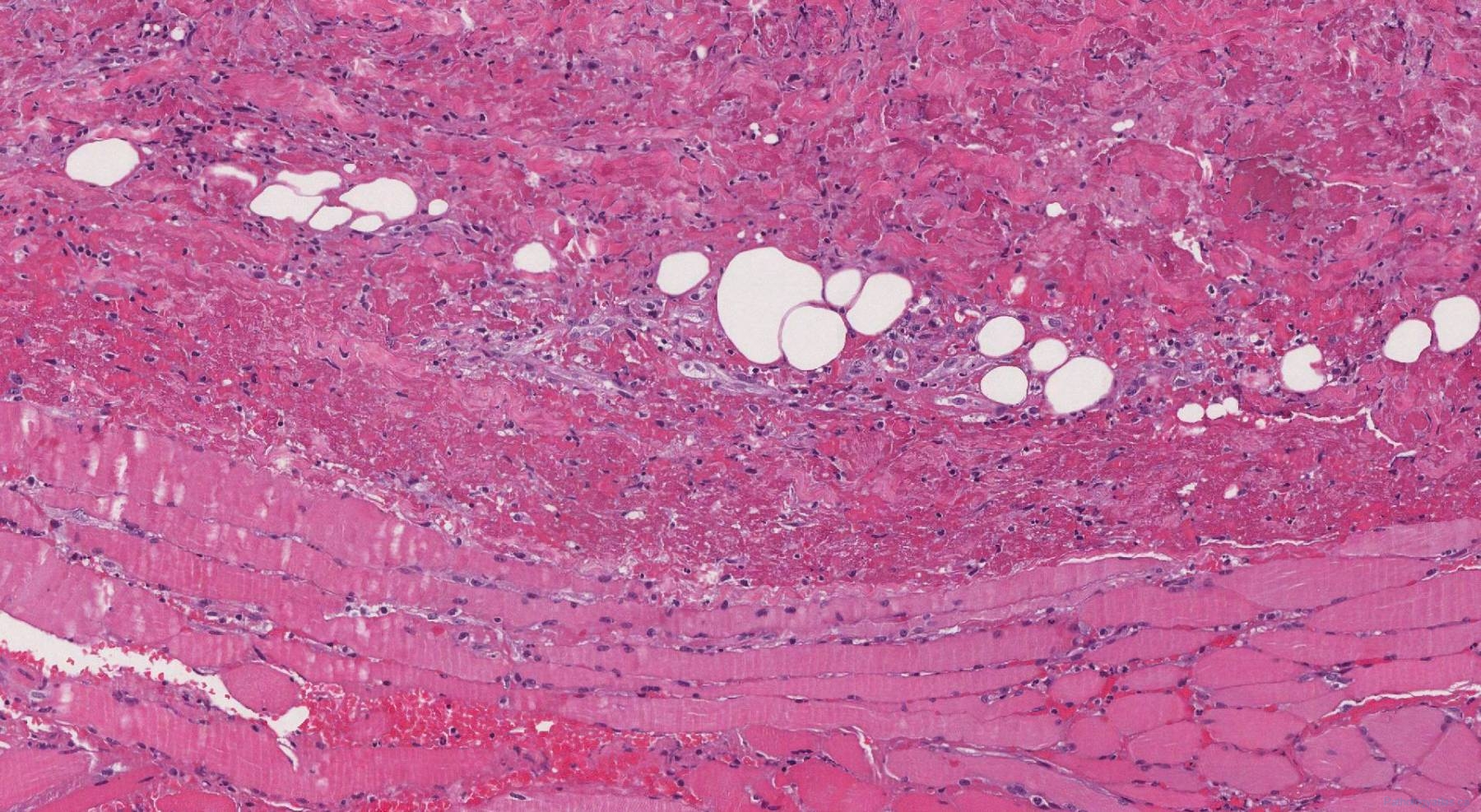 Necrotizing Fasciitis Atlas Of Pathology