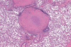 Necrotizing granuloma in the lung