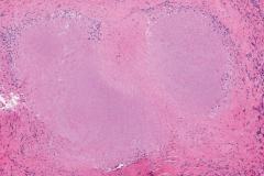 Necrotizing granuloma in the lung