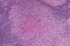 Tuberculosis associated necrotizing granuloma in a lymph node