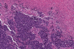 Large cell neuroendocrine carcinoma of the oropharynx