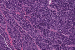 Large cell neuroendocrine carcinoma of the oropharynx