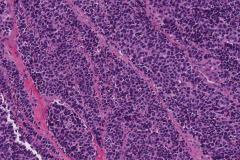 Large cell neuroendocrine carcinoma of the oropharynx